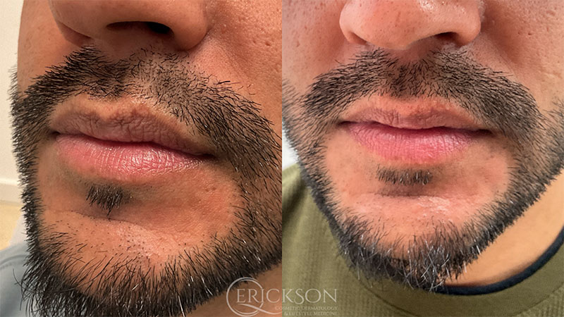 RML Before and After Photo by Dr. Erickson in Chicago, IL