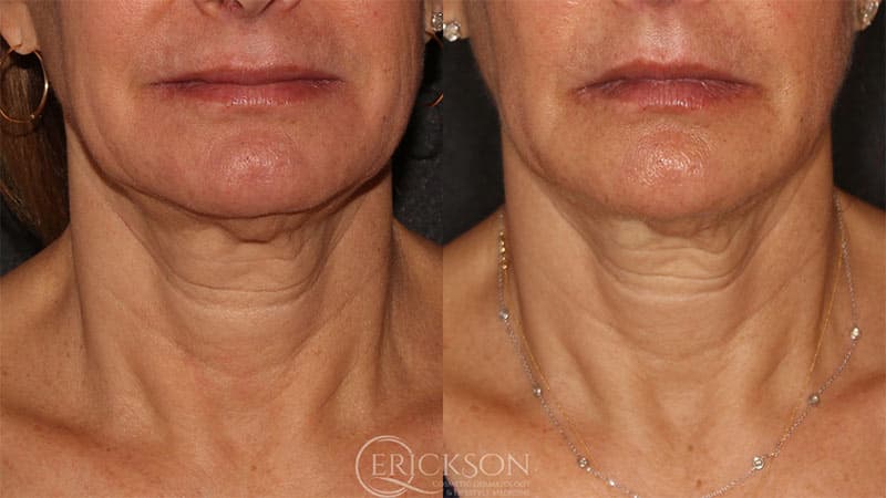 Sofwave Before and After Photo by Dr. Erickson in Chicago, IL