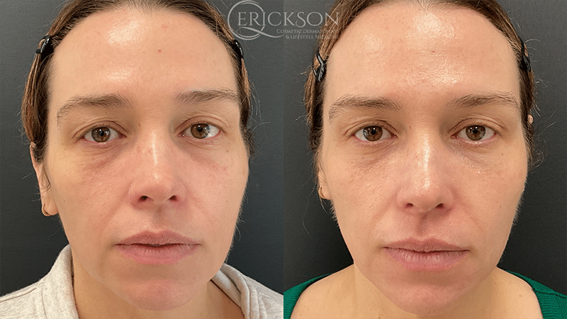 Vampire Facelift Before and After Photo by Dr. Erickson in Chicago, IL