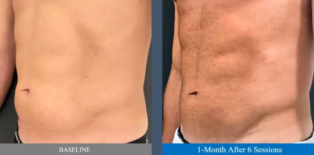 Before and After Image PureImpact™ Treatment by Dr. Erickson in Chicago, IL