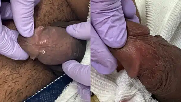 Before and After IMG one at erickson dermatology