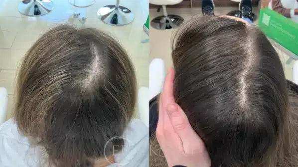 Before and After IMG six at erickson dermatology
