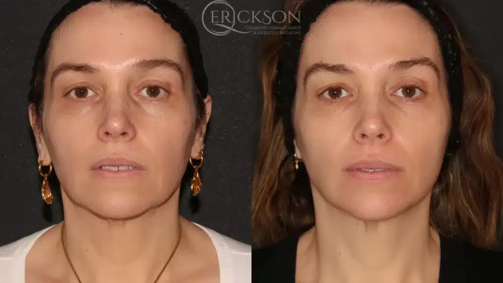 Before and After NEW four at erickson dermatology
