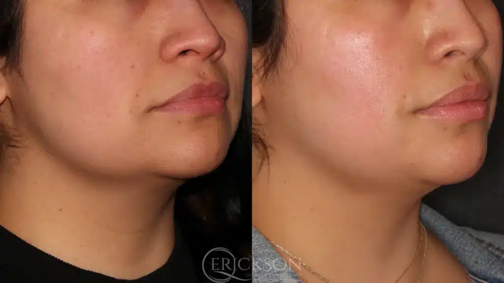 Before and After NEW three at erickson dermatology