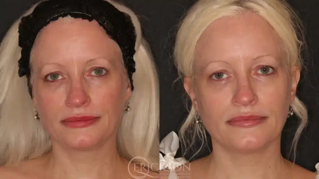 Before and After PIC six at erickson dermatology
