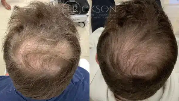 Before and After eight at erickson dermatology