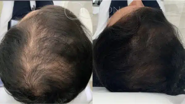 Before and After six at erickson dermatology