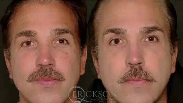 Before and After three at erickson dermatology