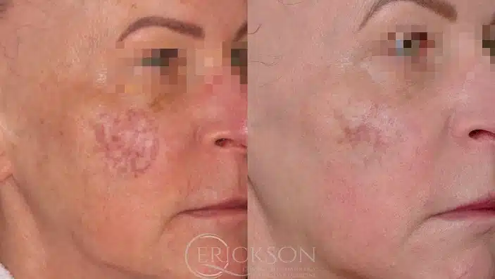 Gallery Before After face raches at Erickson Dermatology