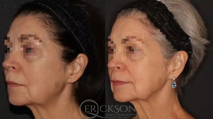 Gallery Before After female face Erickson Dermatology