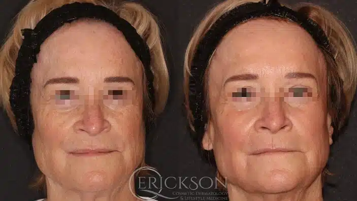 Gallery Before After female facial at Erickson Dermatology