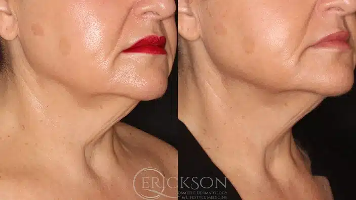 Gallery Before After frmale lips Erickson Dermatology
