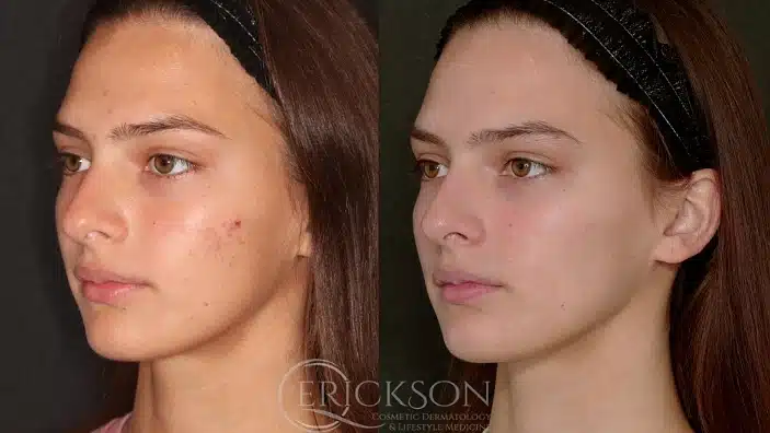 Gallery Before After frmale profile at Erickson Dermatology