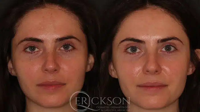 Gallery Before After front angle lady at Erickson Dermatology