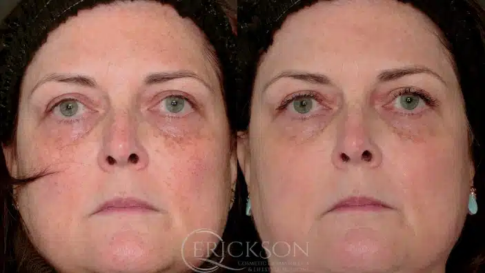 Gallery Before After front face female Erickson Dermatology