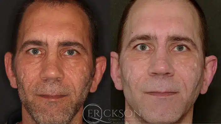 Gallery Before After front face male at Erickson Dermatology
