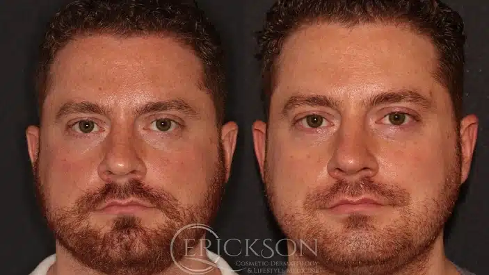 Gallery Before After front view male at Erickson Dermatology