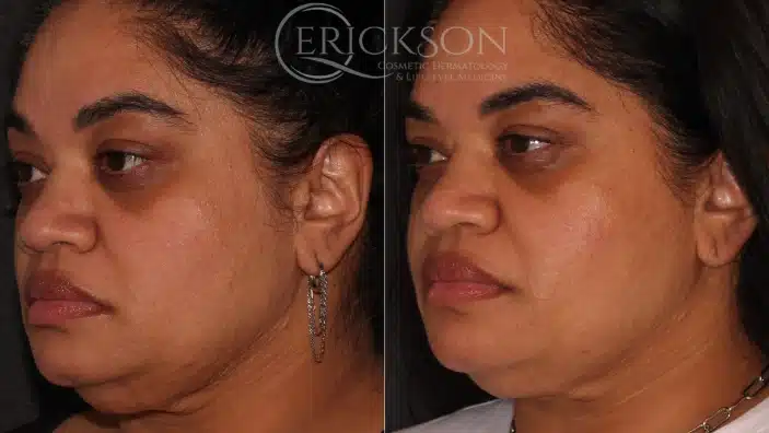 Gallery Before After left sided face Erickson Dermatology