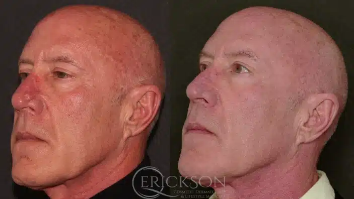Gallery Before After male face Erickson Dermatology