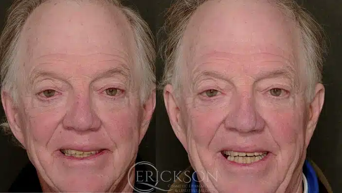 Gallery Before After male face front angle Erickson Dermatology