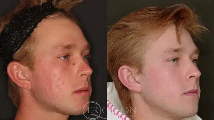 Gallery Before After male face lines Erickson Dermatology