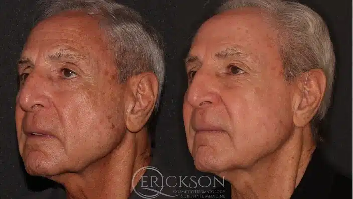 Gallery Before After male face pics Erickson Dermatology
