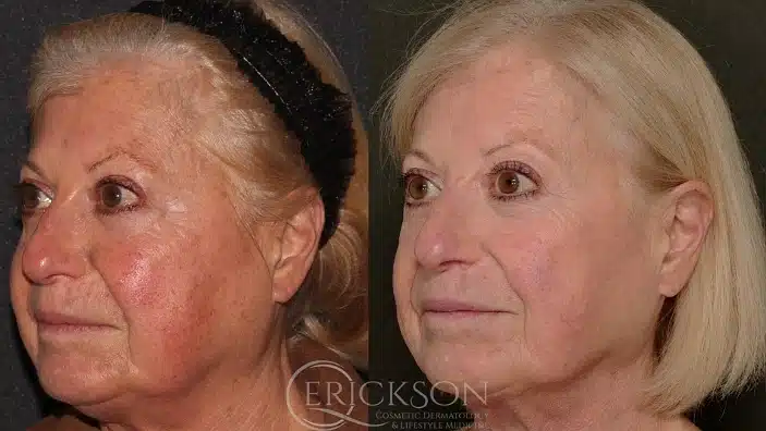 Gallery Before After sideview female Erickson Dermatology