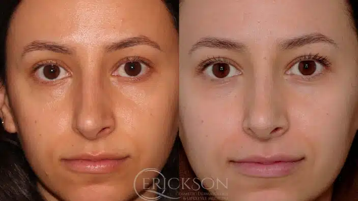 Gallery Before After small face female Erickson Dermatology
