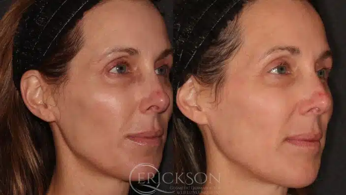 Gallery Before After yang lady at Erickson Dermatology