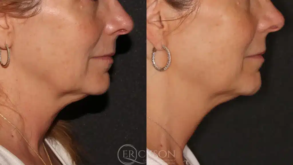 Gallery Before and After nine at erickson dermatology