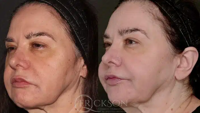 Gallery Before and After pics one at erickson dermatology