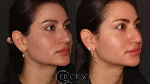 Gallery Before and After seven at erickson dermatology