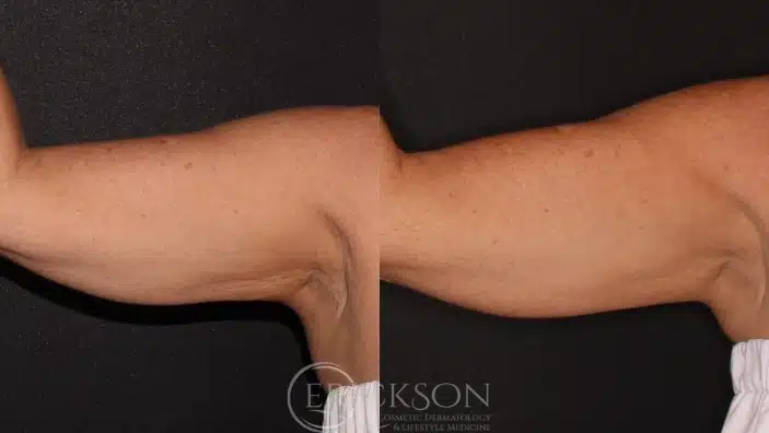 Gallery Before and After skin tightning one at erickson dermatology