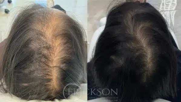 Gallery Before and After three at erickson dermatology
