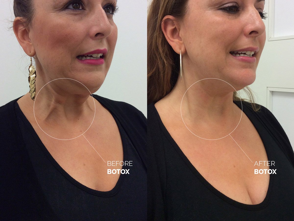 botox-neck-before-after-erickson