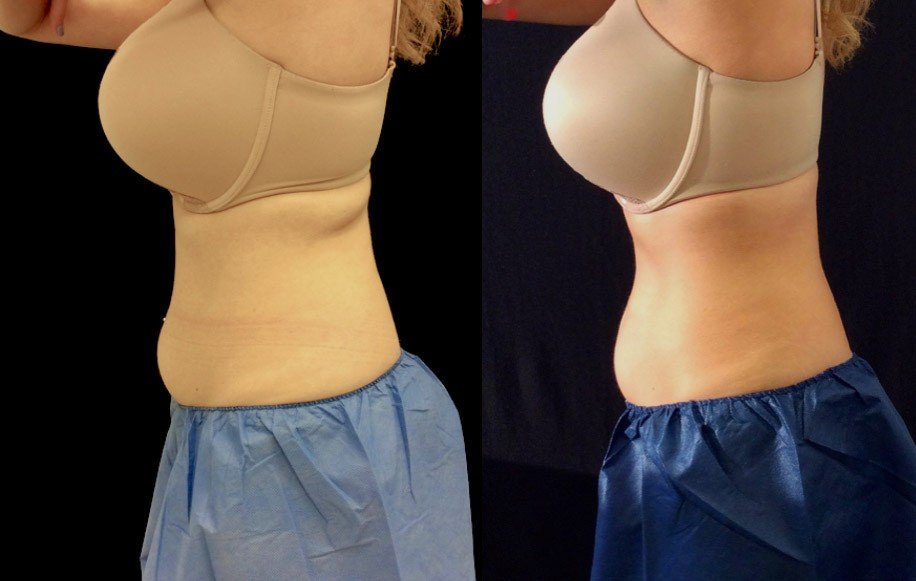 Coolsculpting Before After 5