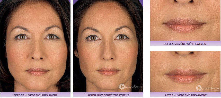 juvederm-xc-before-after-2