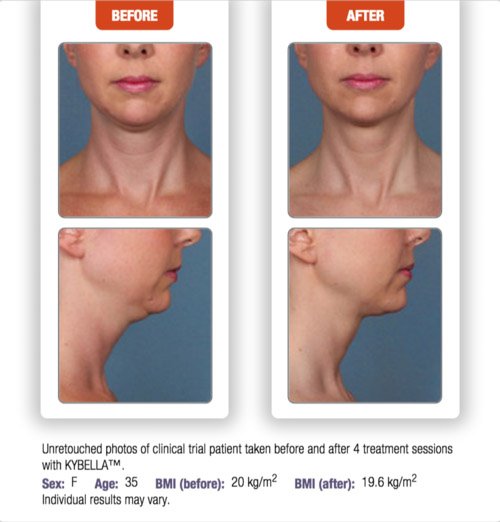 kybella-before-after-1