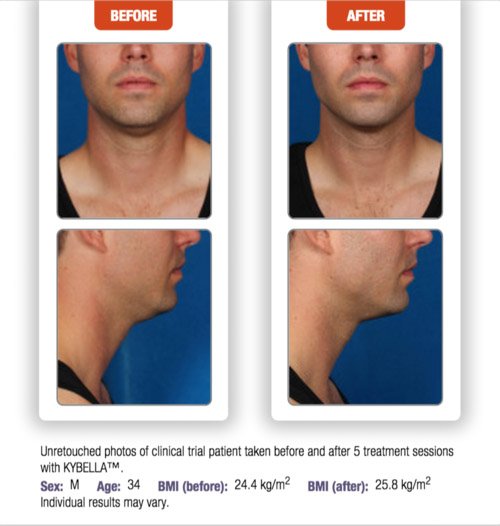 kybella-before-after-3
