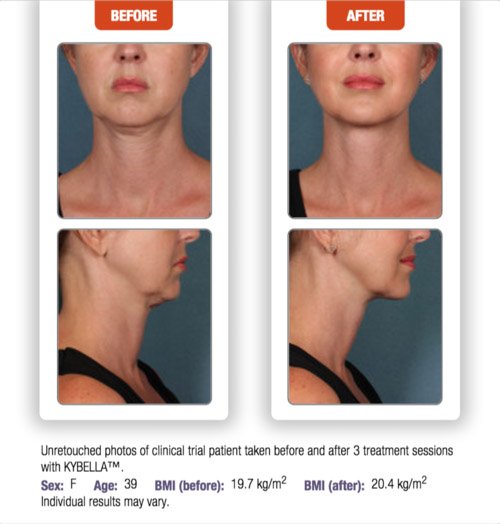 kybella-before-after-4
