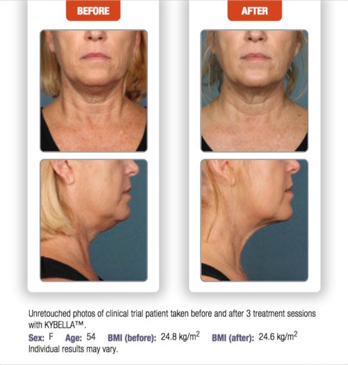 kybella-before-after-6