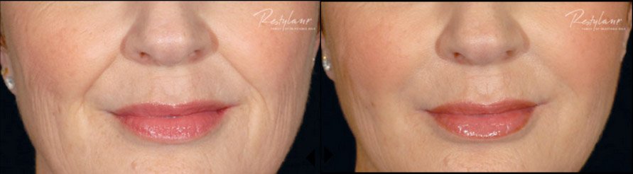 restylane-restylane-l-before-after-2