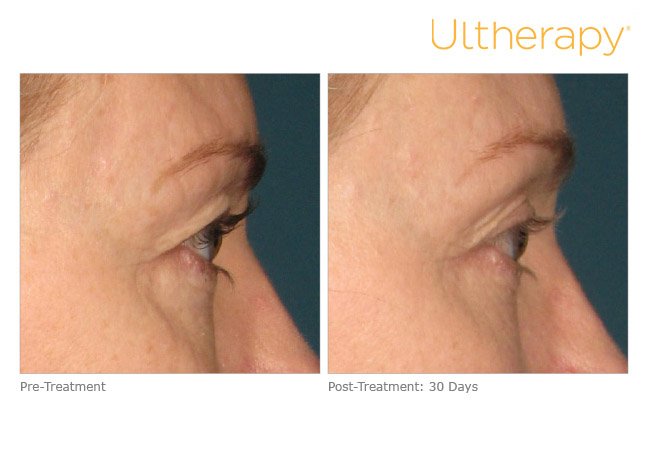 ultherapy-brow-before-after-2