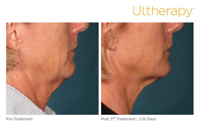 ultherapy-lower-face-before-after-1