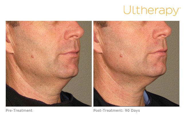 ultherapy-lower-face-before-after-2