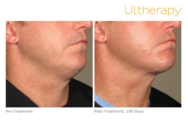 ultherapy-lower-face-before-after-3