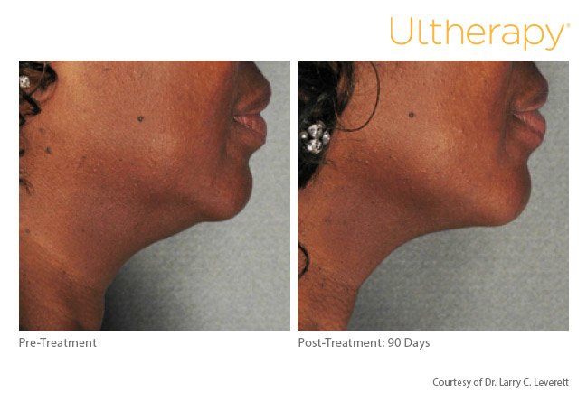 ultherapy-lower-face-before-after-4