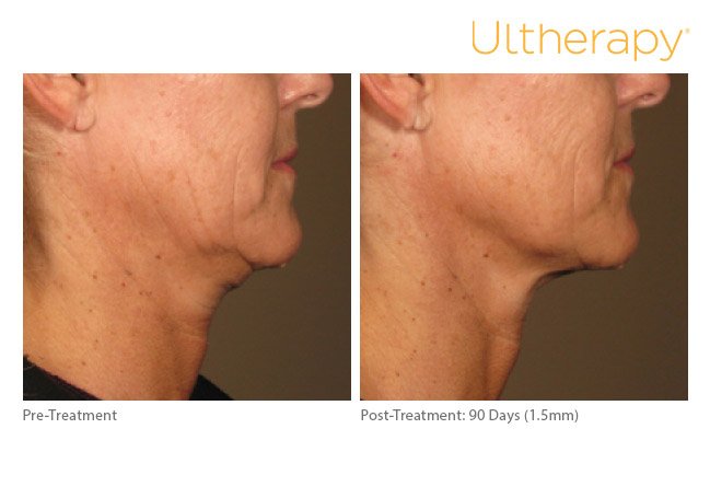ultherapy-lower-face-before-after-6
