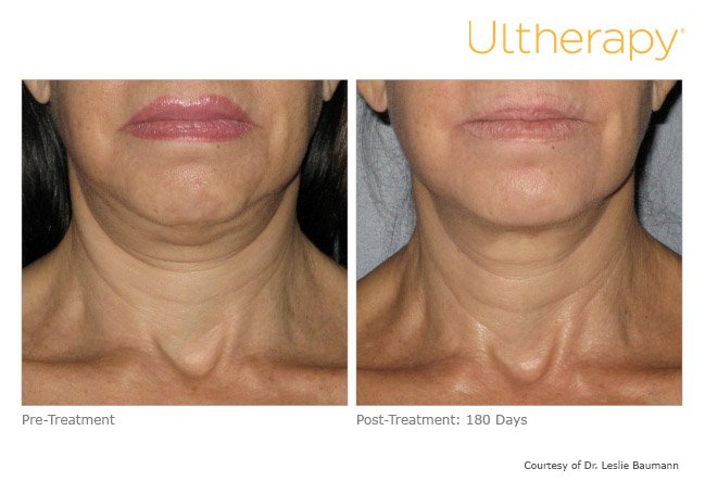 ultherapy-neck-before-after-1