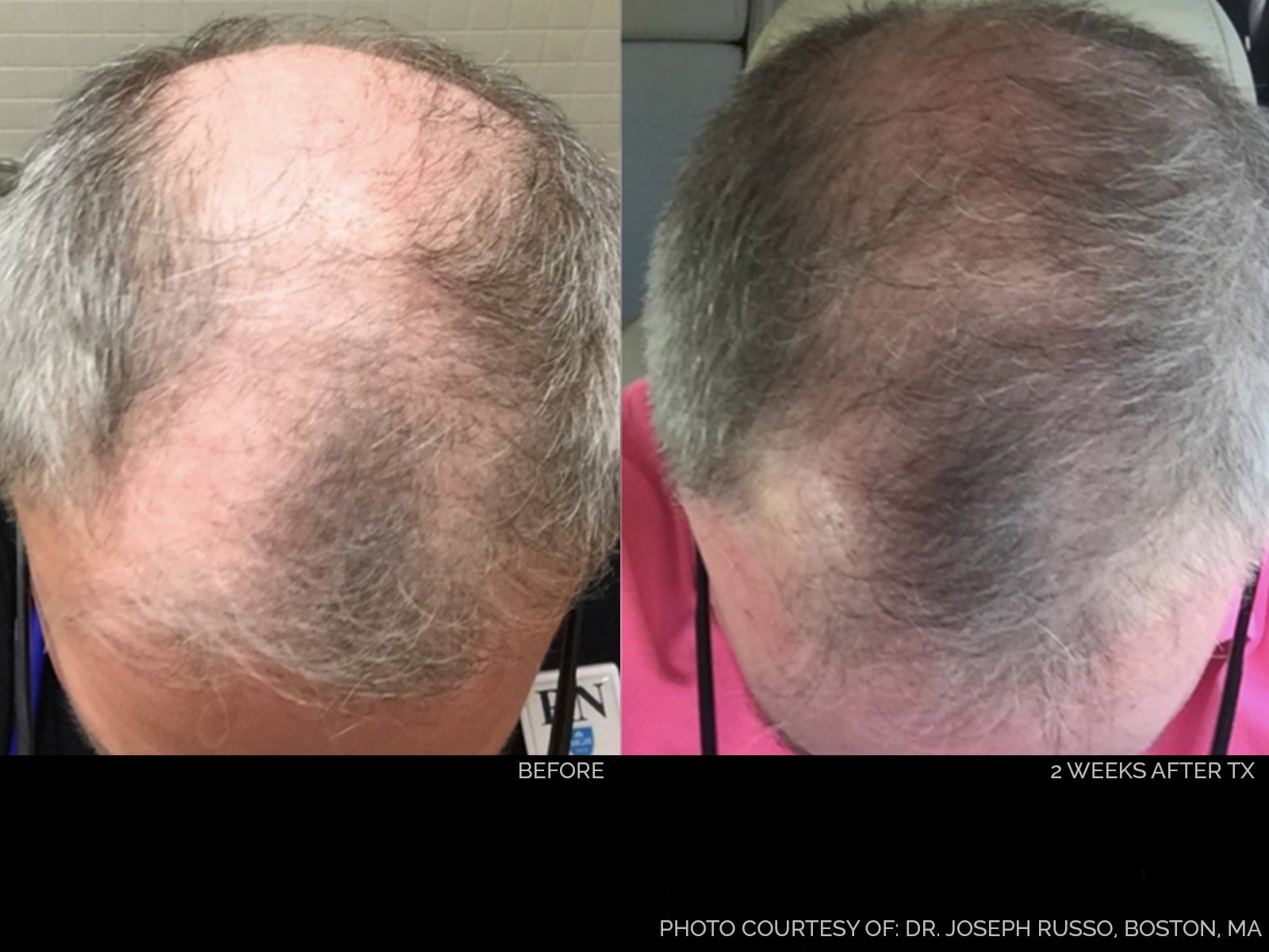 hair-rejuvenation-before-after-2